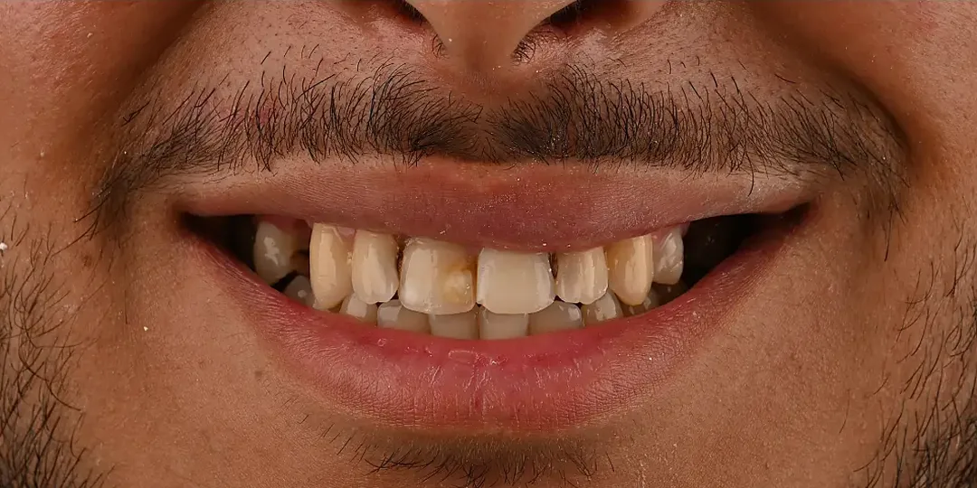 Avant&nbsp;: des dents du haut jaunies, dont une plus foncée, aux bords irréguliers