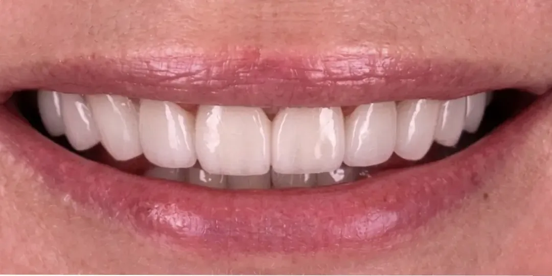 Après&nbsp;: l’espace refermé, les dents du haut blanches et régulières