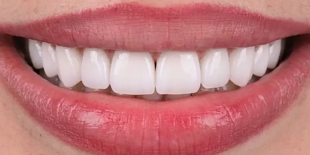 Après&nbsp;: des dents plus longues, blanches et régulières