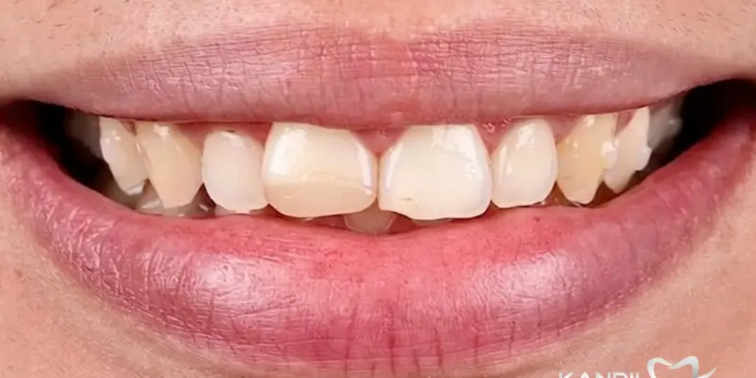 Avant&nbsp;: des incisives courtes aux bords usés, des dents jaunies