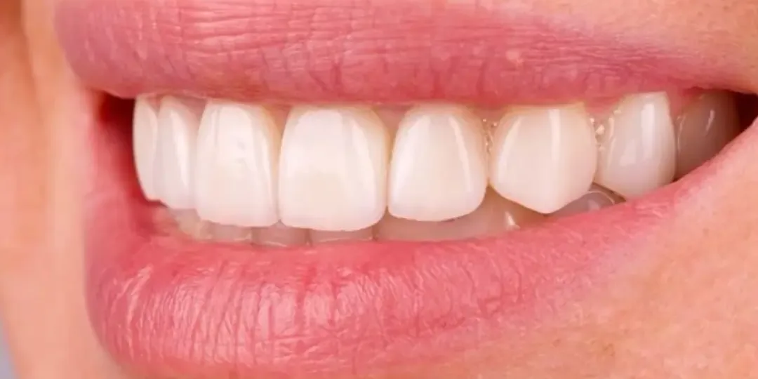 Après&nbsp;: des dents blanches aux bords réguliers, vues de trois quarts