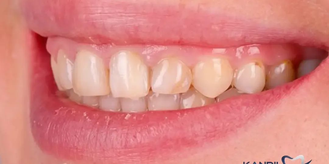 Avant&nbsp;: des bords ébréchés et une teinte brunie, inégale d’une dent à l’autre
