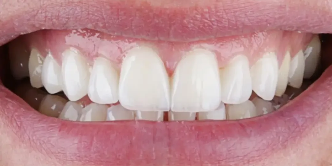 Après&nbsp;: les dents du haut de longueur régulière