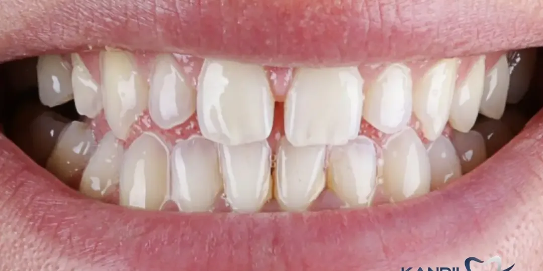 Avant&nbsp;: une incisive latérale en retrait, des dents de longueurs inégales