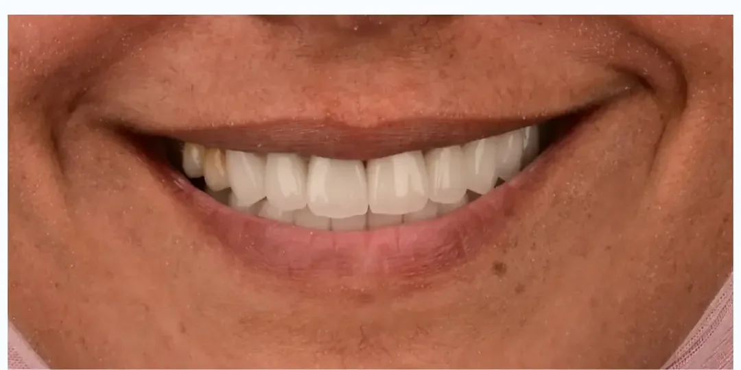 Après&nbsp;: des dents plus longues, de teinte uniforme