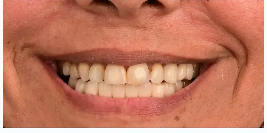 Avant&nbsp;: des dents du haut raccourcies par l’usure, irrégulières, tachées près de la gencive