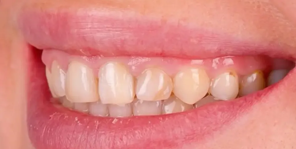 Dents antérieures décolorées avant la pose de facettes E.max à Mohammedia