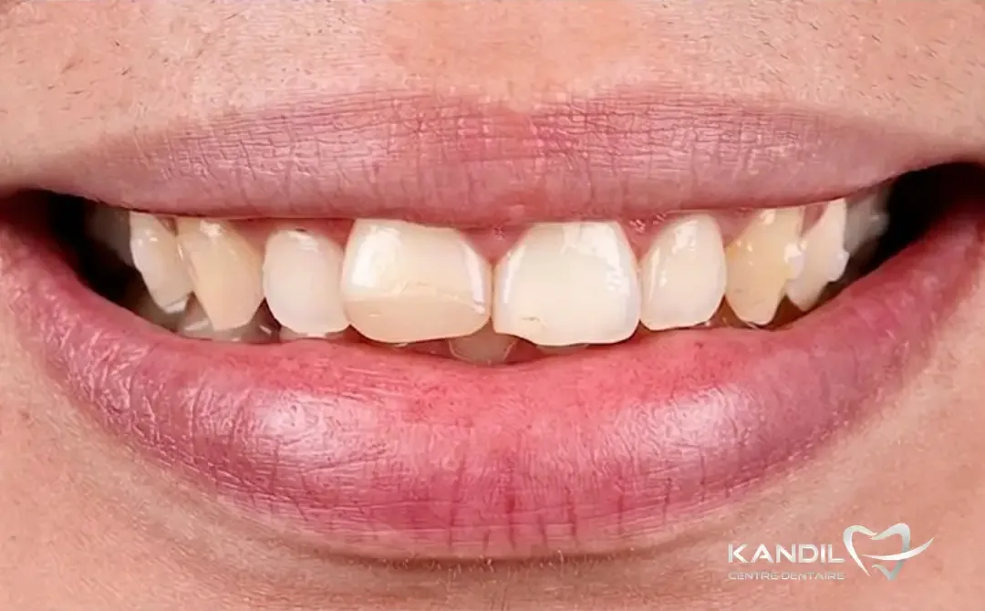Avant&nbsp;: dents jaunies aux bords ébréchés