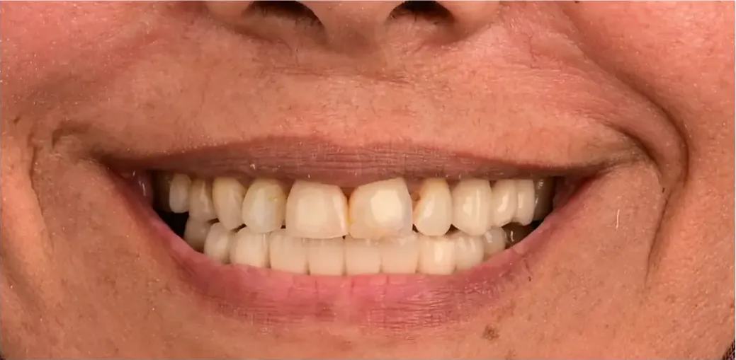 Avant&nbsp;: dents irrégulières et espacées
