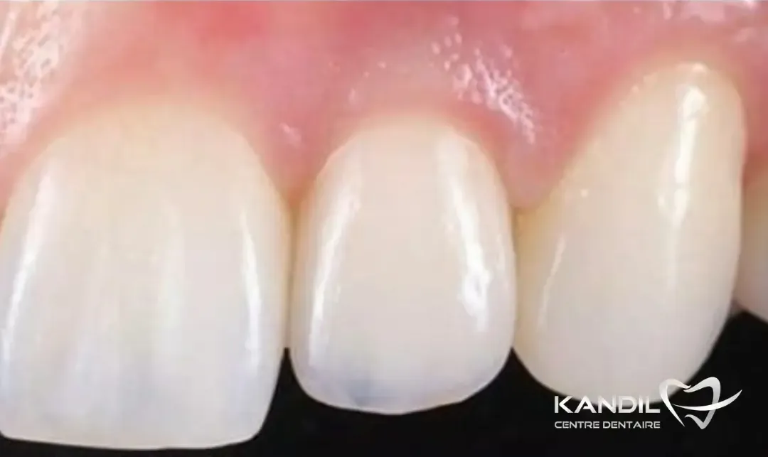 Après&nbsp;: l’incisive remplacée par un implant et sa couronne en céramique, Centre Dentaire Kandil à Mohammedia