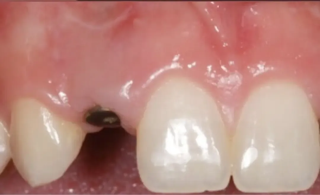 Le pilier de l’implant en place sur une incisive latérale