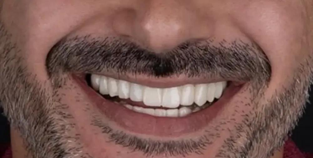 Sourire complet après réhabilitation implantaire, Centre Dentaire Kandil Mohammedia