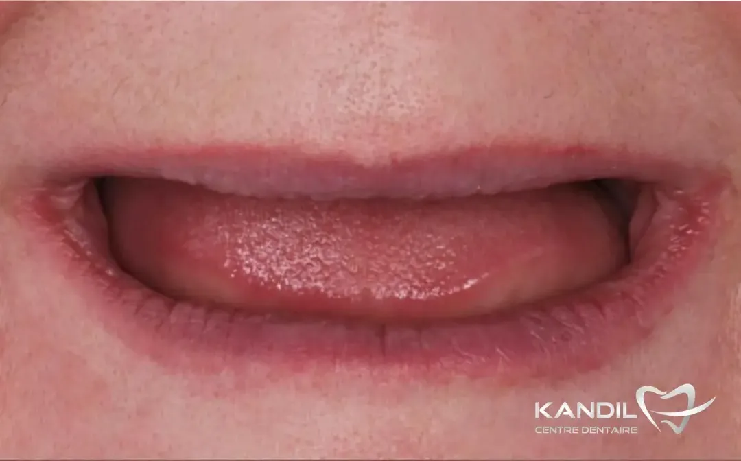 Mâchoire du haut sans dents, avant la pose des implants au Centre Dentaire Kandil