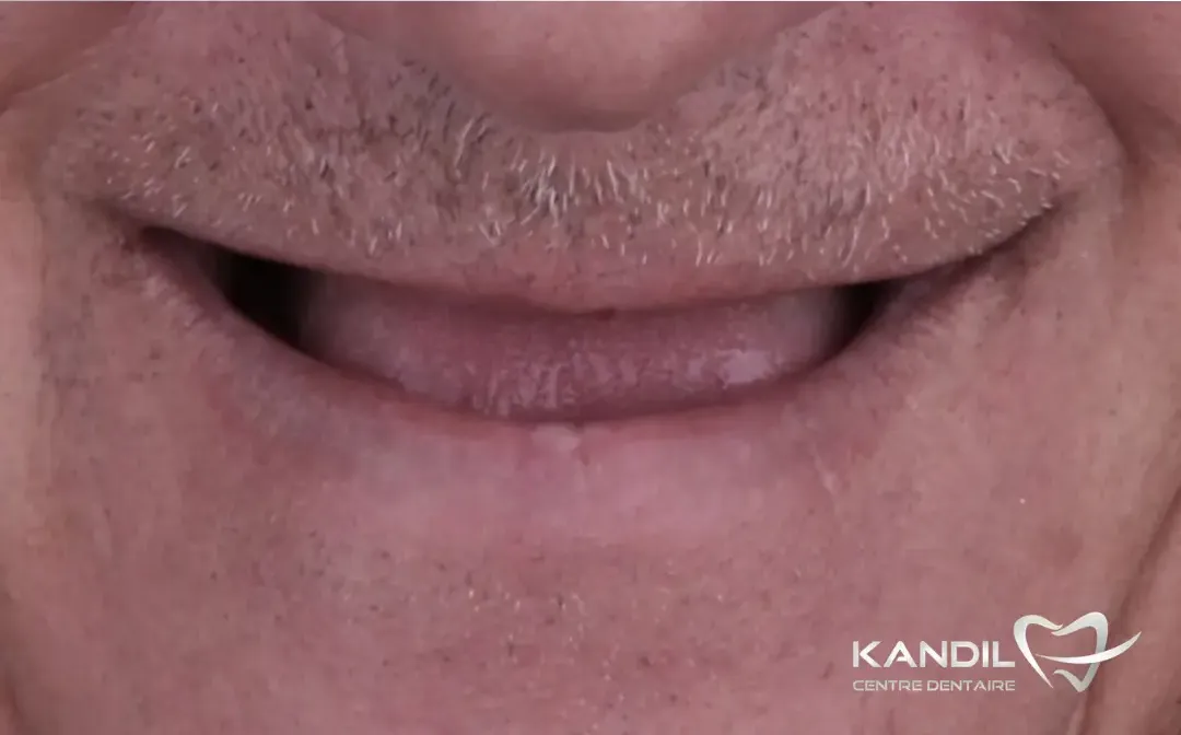 Une autre mâchoire du haut sans dents, avant la pose des implants au Centre Dentaire Kandil