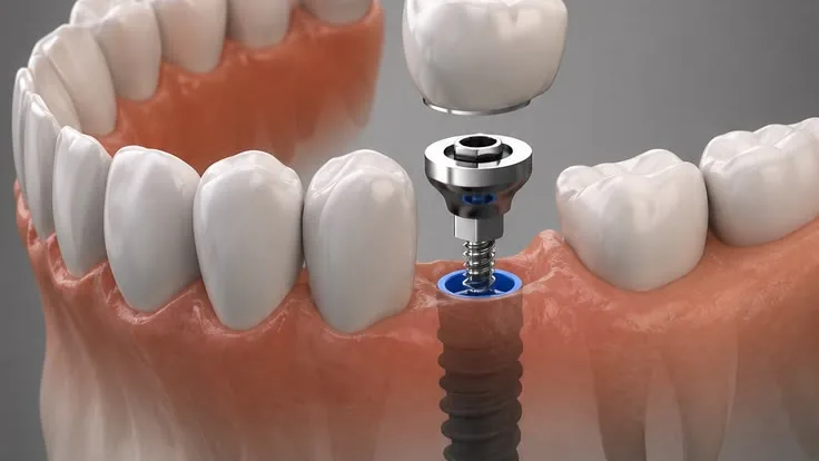 Illustration d’un implant dentaire, de son pilier et de la couronne qui s’y fixe
