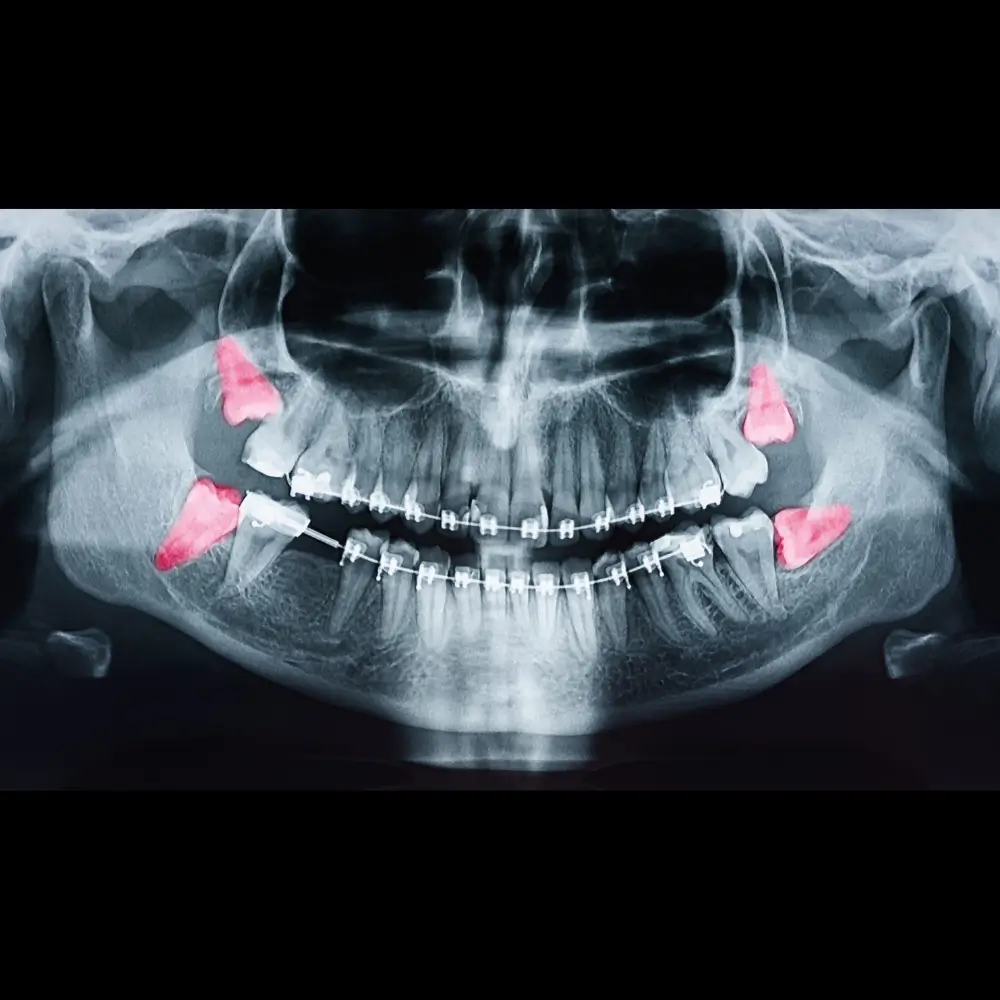 Radiographie montrant des dents de sagesse incluses et problématiques, nécessitant une extraction au Centre Dentaire Kandil à Mohammedia.