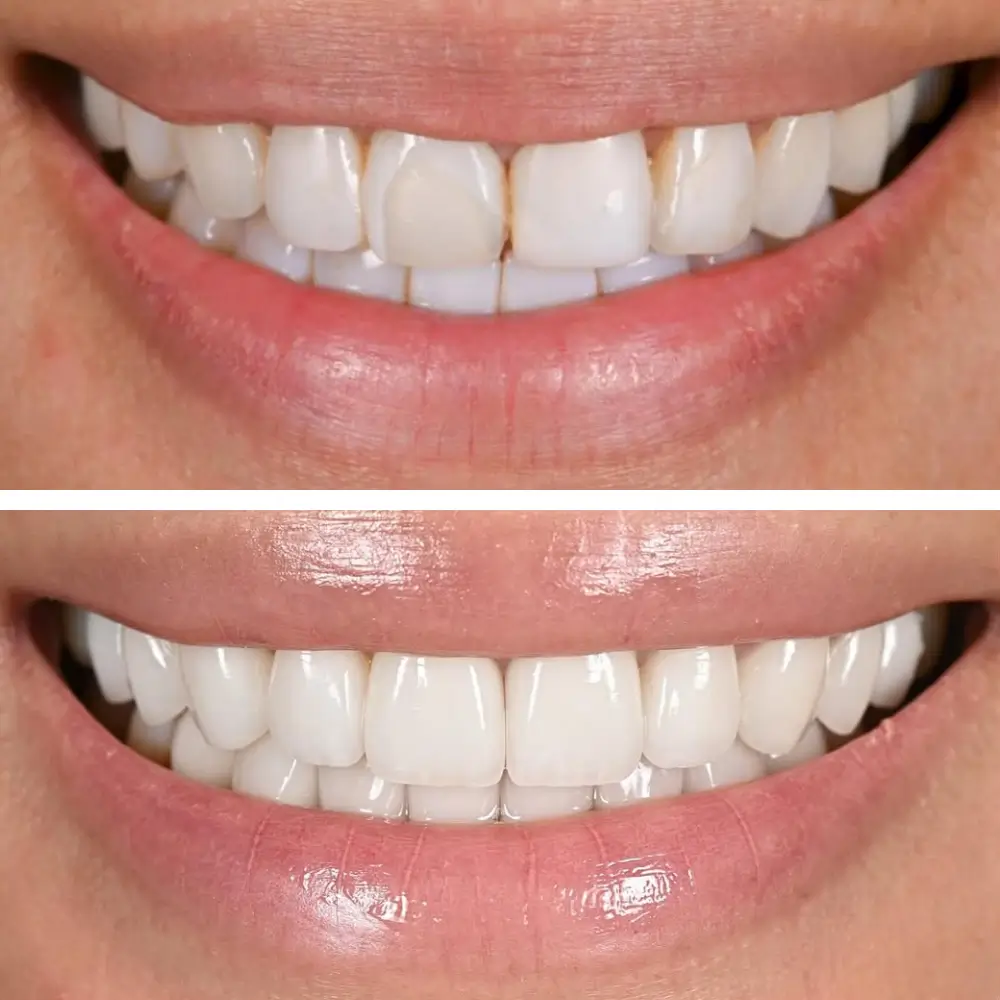 Avant-après d’une restauration esthétique du sourire, montrant l’amélioration de la forme et de l’harmonie des dents au Centre Dentaire Kandil à Mohammedia.