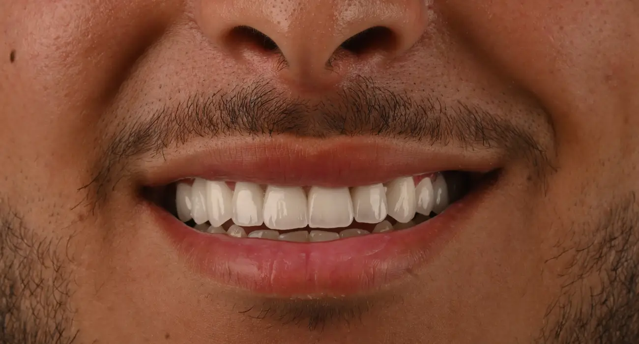 apres rehabilitation esthetique chez centre dentaire kandil à mohammedia