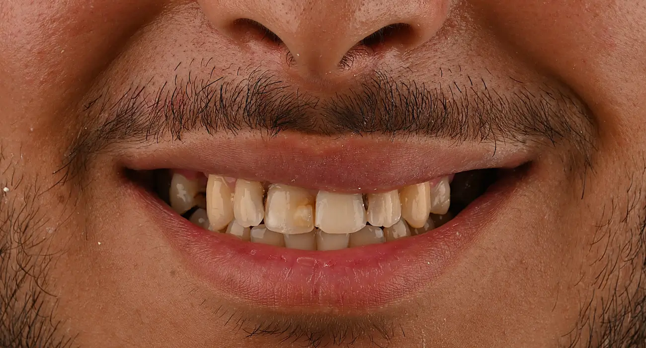 avant rehabilitation esthetique chez centre dentaire kandil à mohammedia