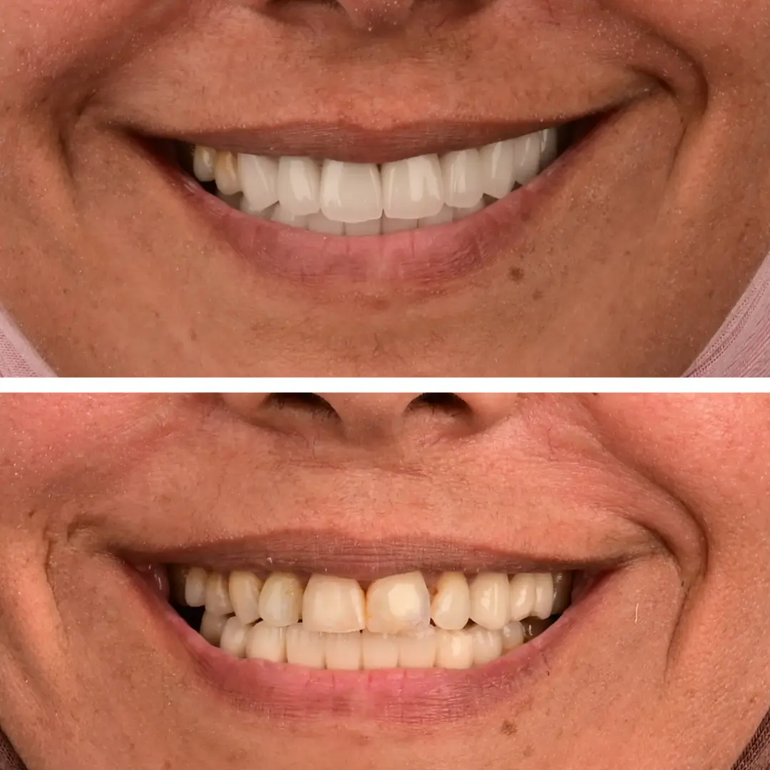 cas esthetique realisé par dr sami kandil au centre dentaire kandil mohammedia