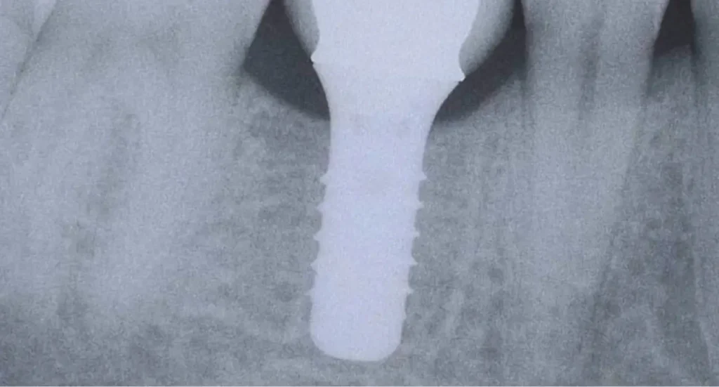 implant dentaire - Mohammedia