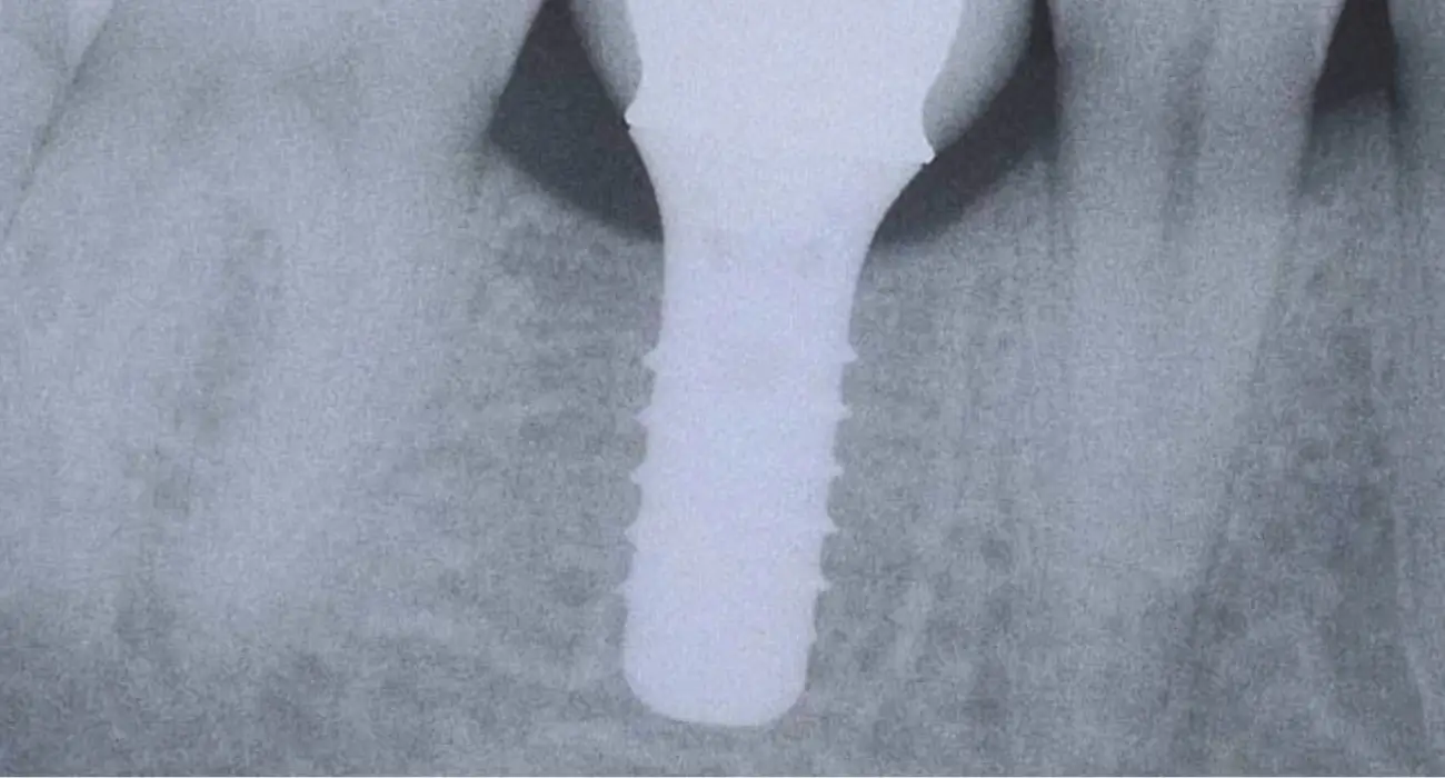 Radiographie d'un implant dentaire intégré dans l'os, Centre Dentaire Kandil à Mohammedia