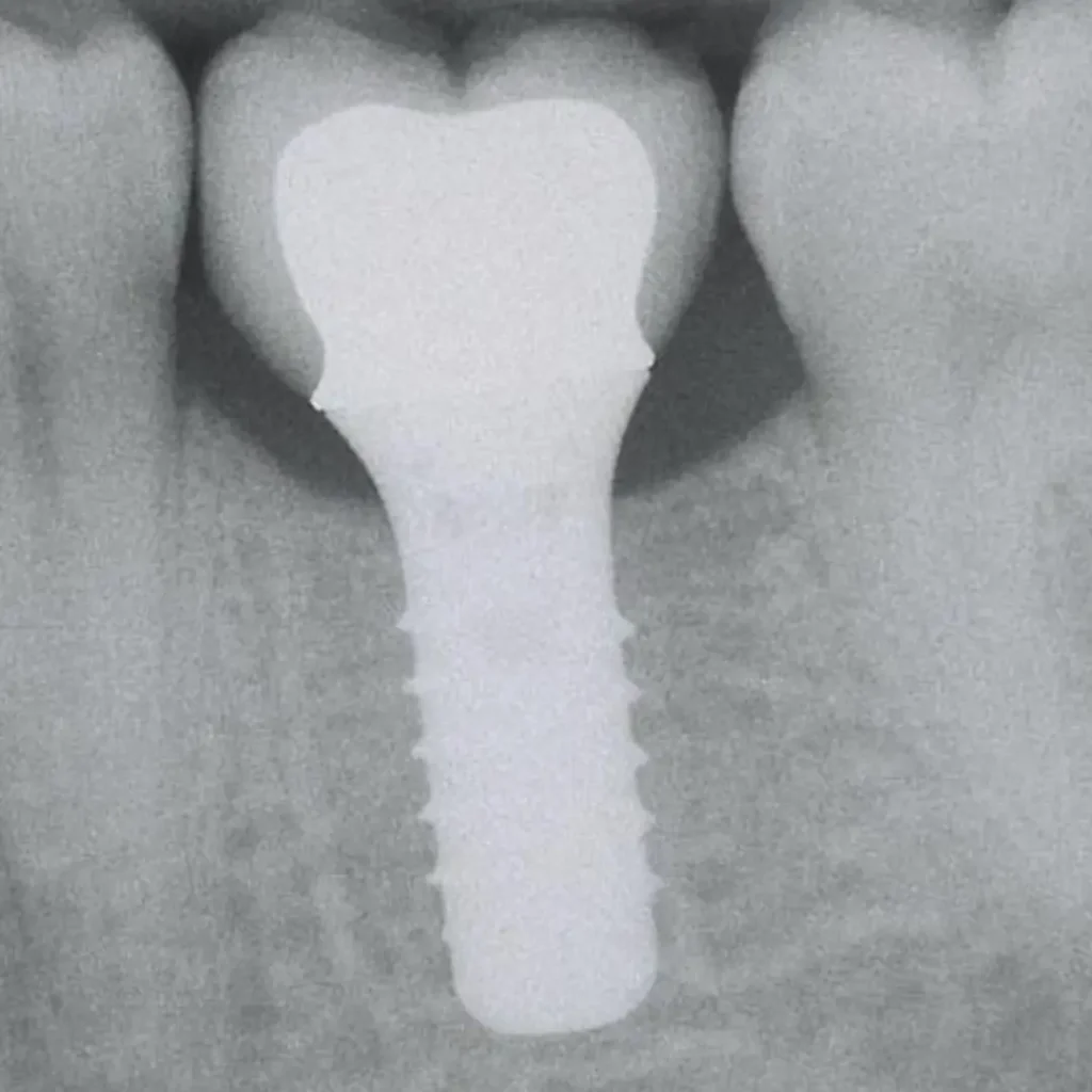 implant dentaire - Mohammedia