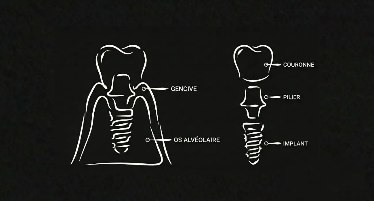 Schéma d'un implant dentaire : implant, pilier prothétique et couronne