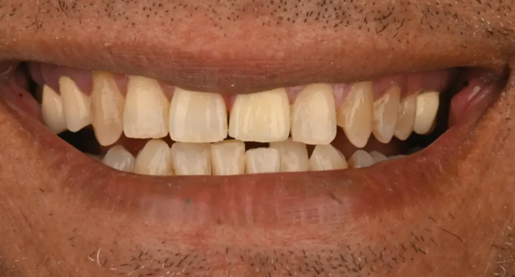 Résultat après traitement par facettes dentaires au Centre Dentaire Kandil à Mohammedia, près de Casablanca, Maroc