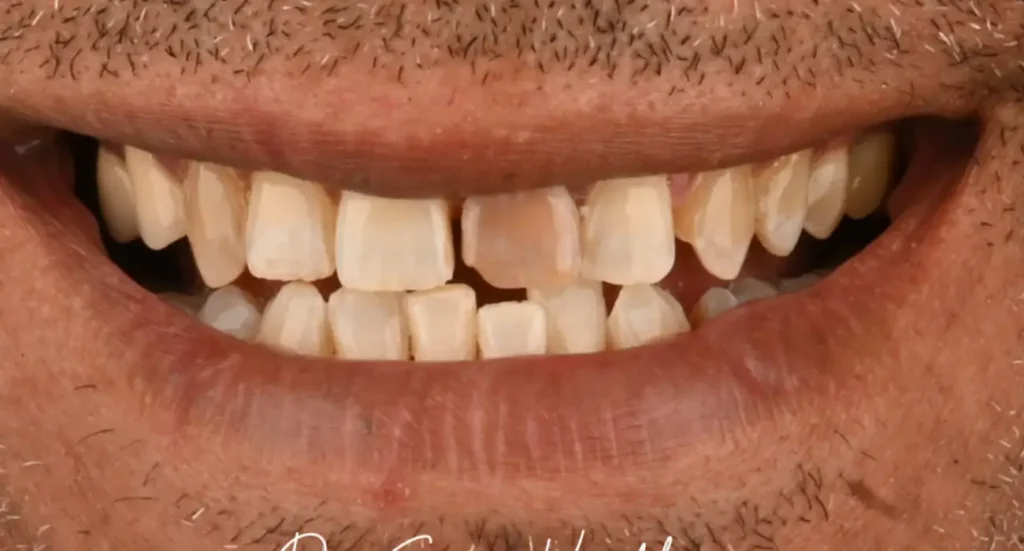 État du sourire avant traitement par facettes dentaires au Centre Dentaire Kandil à Mohammedia, près de Casablanca, Maroc