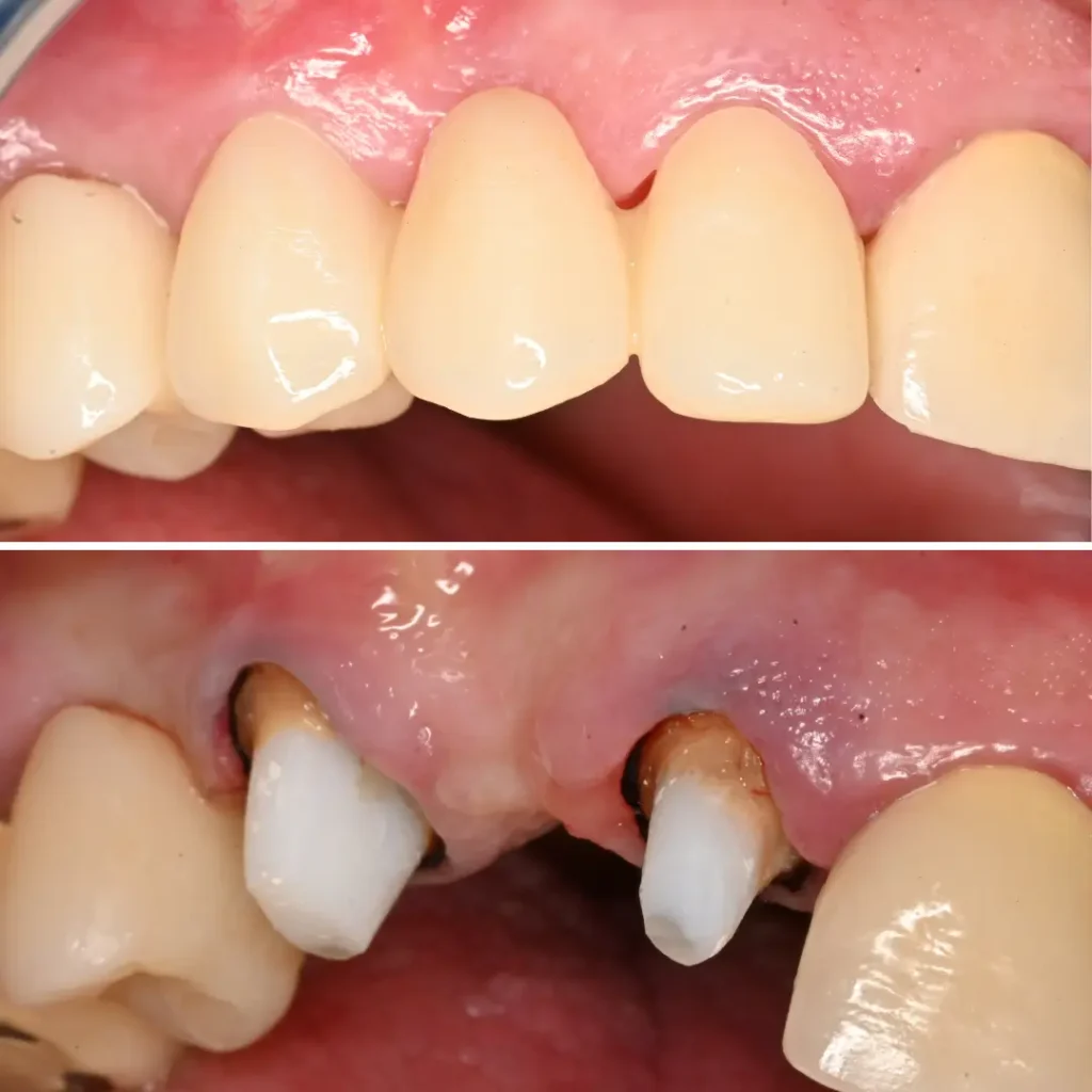 Avant après bridge dentaire pour remplacer une dent manquante au Centre Dentaire Kandil à Mohammedia Maroc