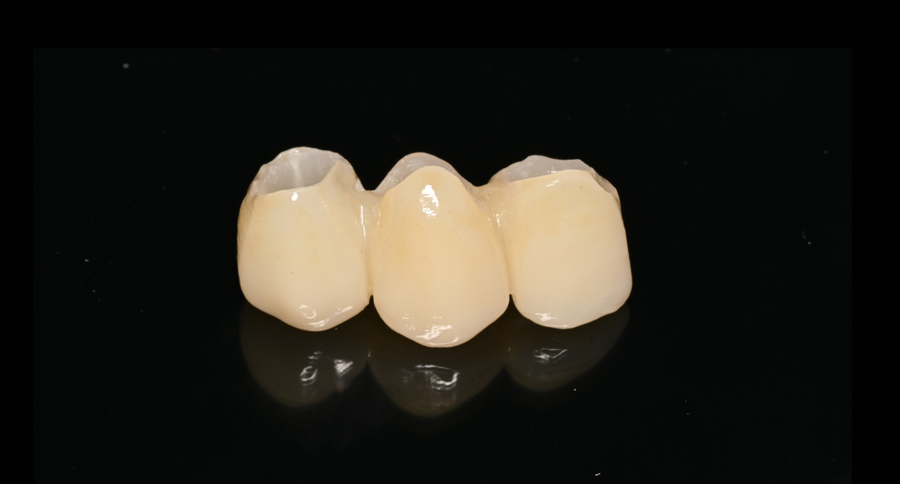 bridge-dentaire-zircone-prothese-fixe-mohammedia-maroc