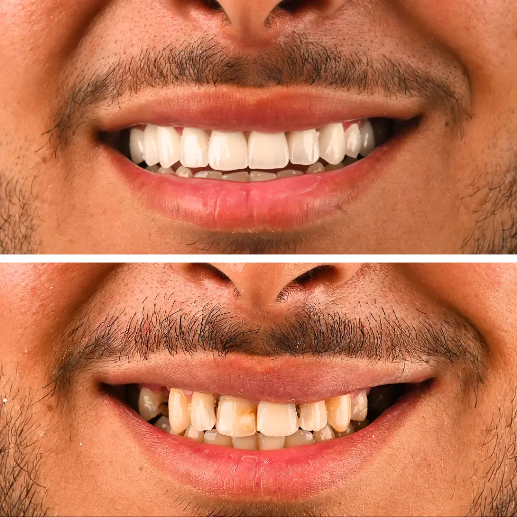 Avant et après un traitement par facettes dentaires montrant une amélioration de la teinte, de l’alignement et de l’harmonie du sourire chez un patient adulte à Mohammedia.