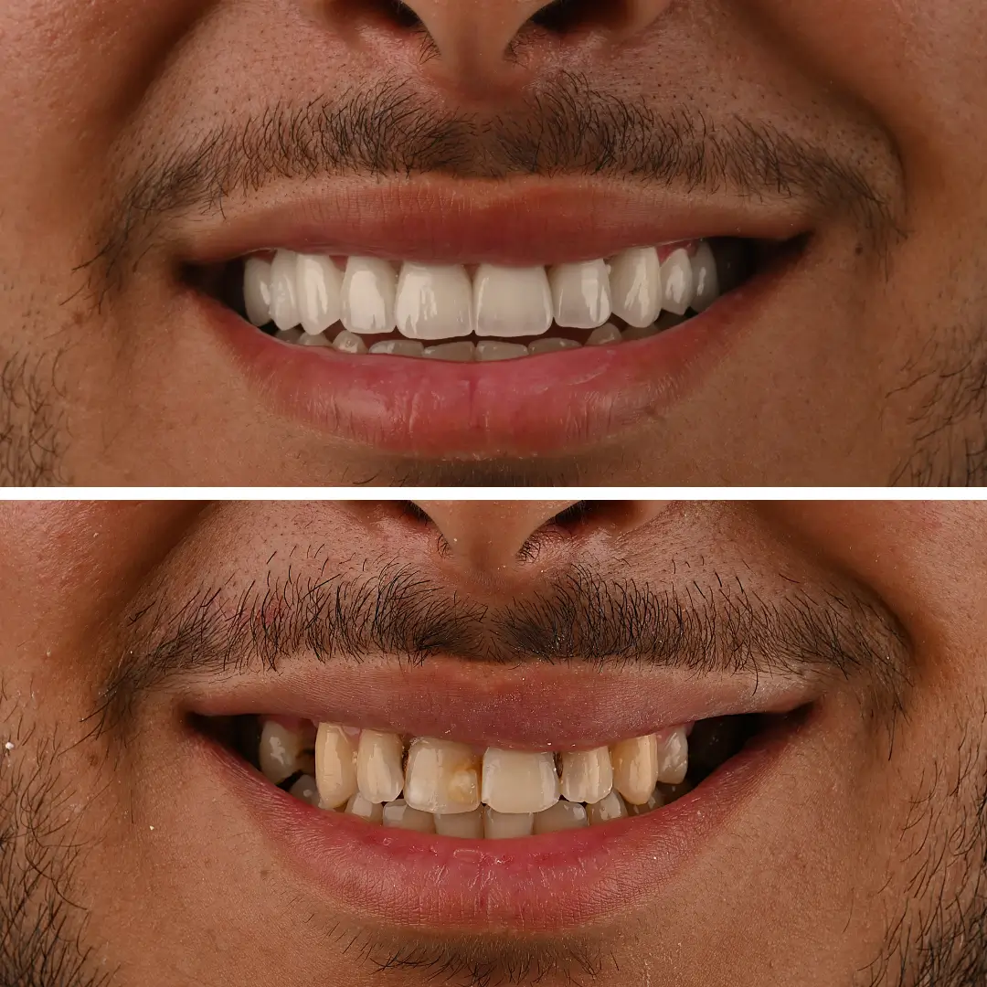 centre-dentaire-kandil-facettes-dentaires-avant-apres-sourire-homme-esthetique-mohammedia (2)