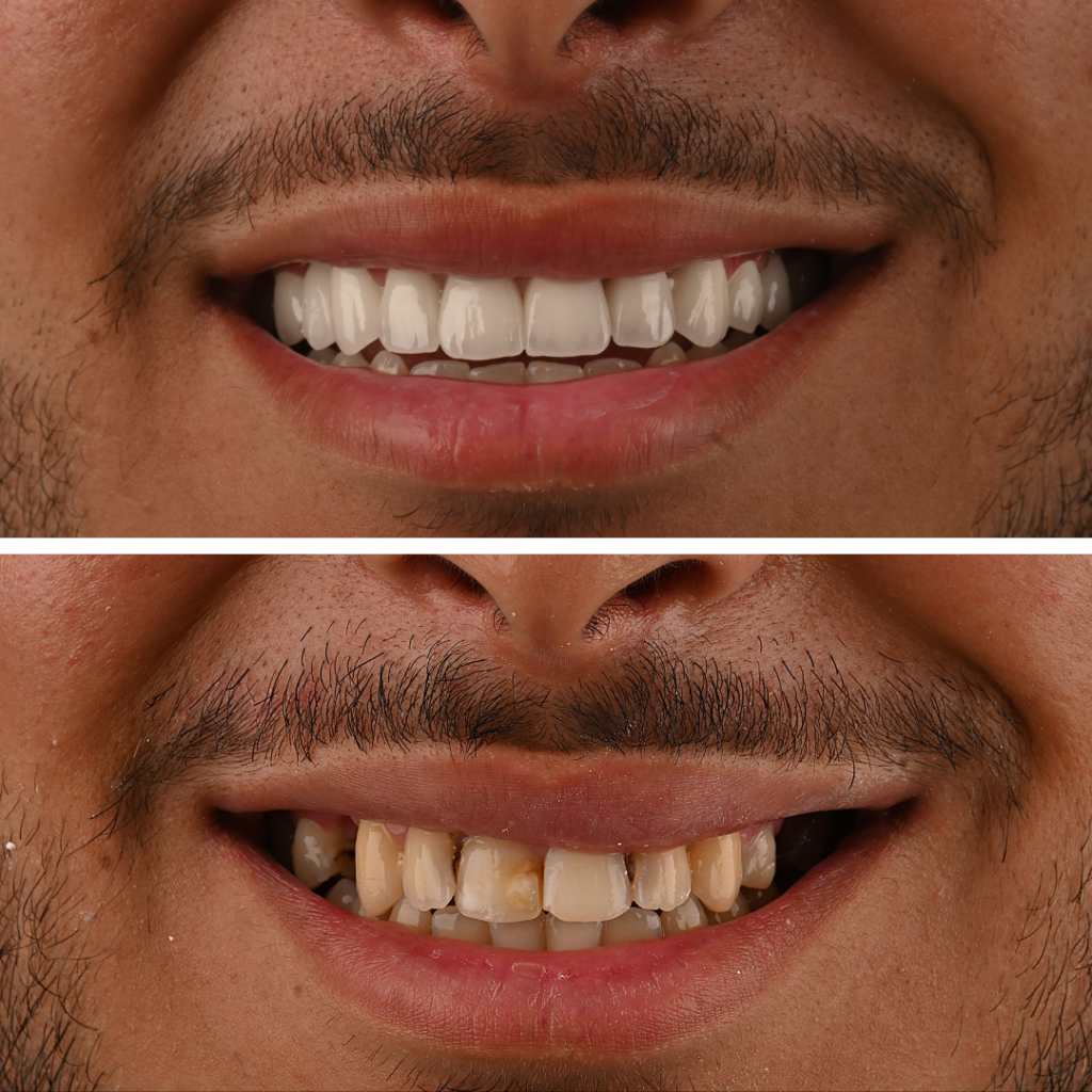 Avant et après un traitement par facettes dentaires montrant une amélioration de la teinte, de l’alignement et de l’harmonie du sourire chez un patient adulte à Mohammedia.