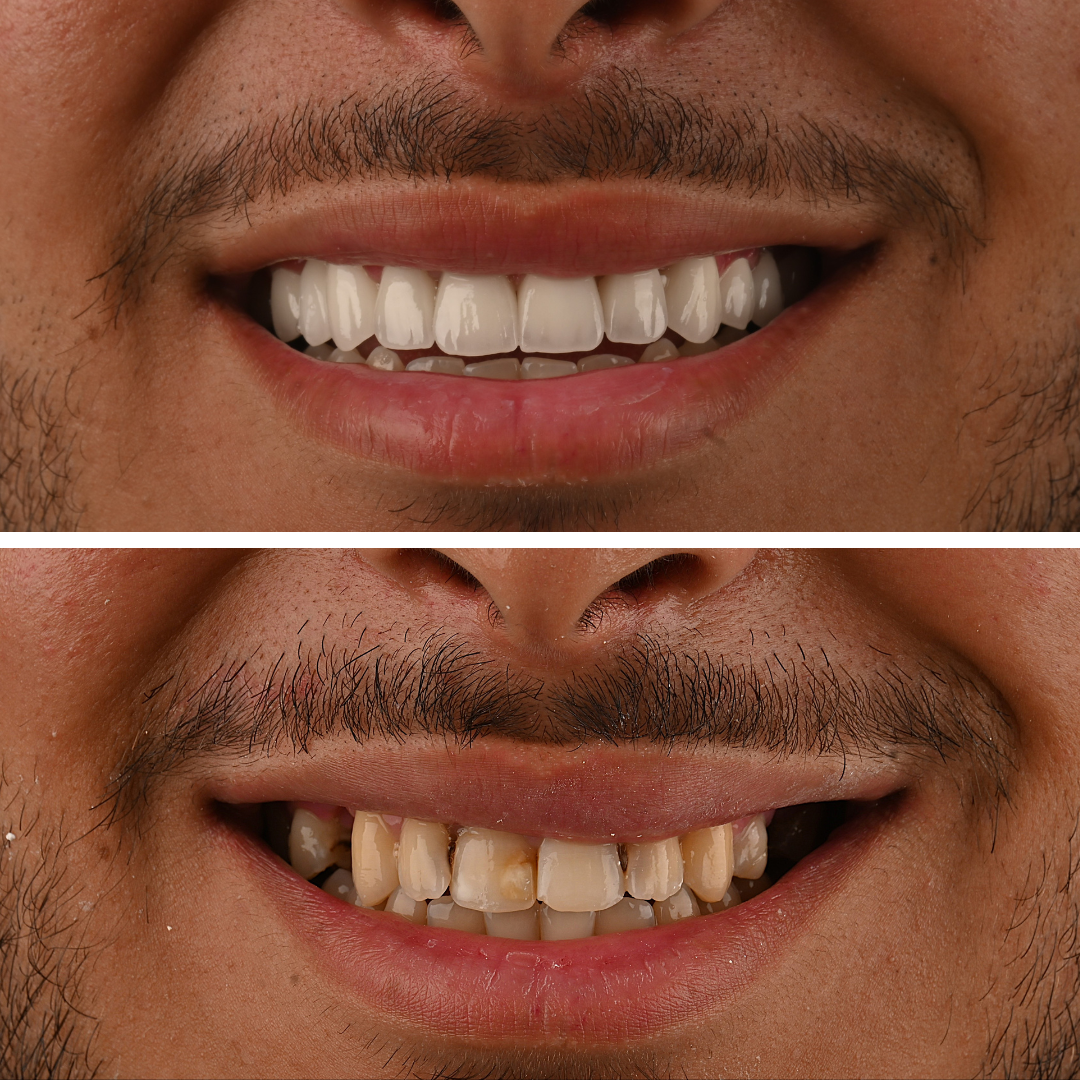 Avant et après un traitement par facettes dentaires montrant une amélioration de la teinte, de l’alignement et de l’harmonie du sourire chez un patient adulte à Mohammedia.