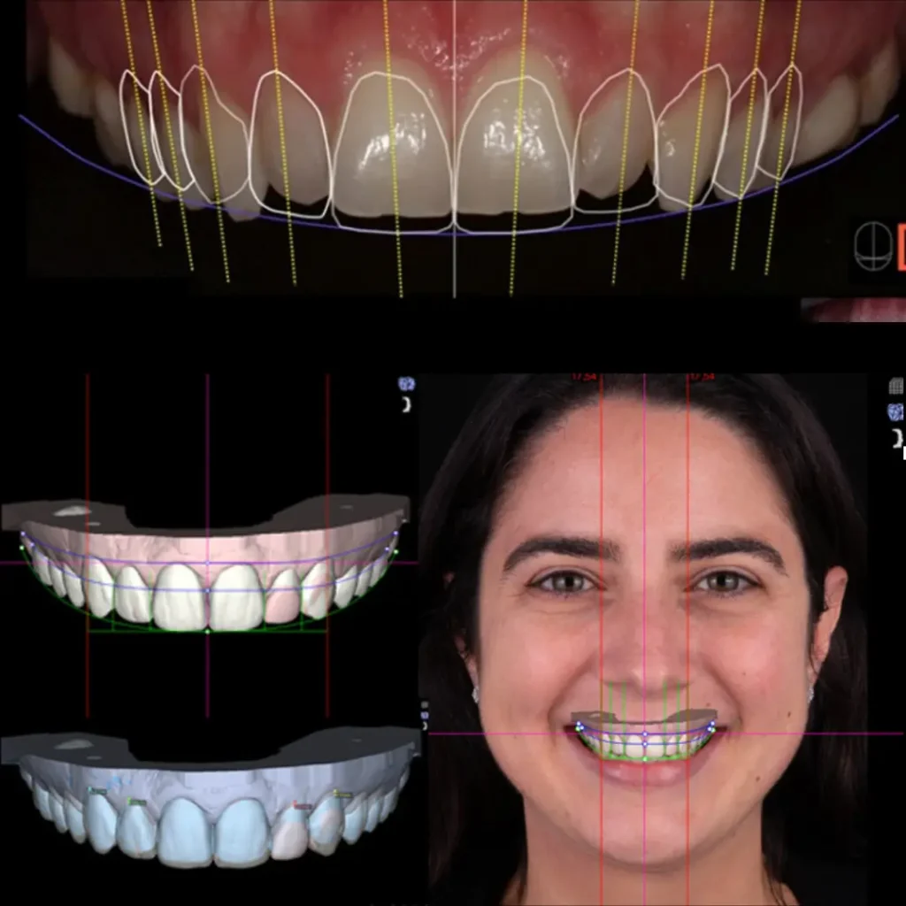 Analyse du sourire par Digital Smile Design (DSD) montrant la planification esthétique numérique des dents et l’harmonisation du sourire avec le visage chez une patiente adulte à Mohammedia.