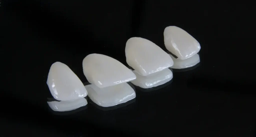 Facettes dentaires en céramique sur mesure utilisées au Centre Dentaire Kandil à Mohammedia, Maroc