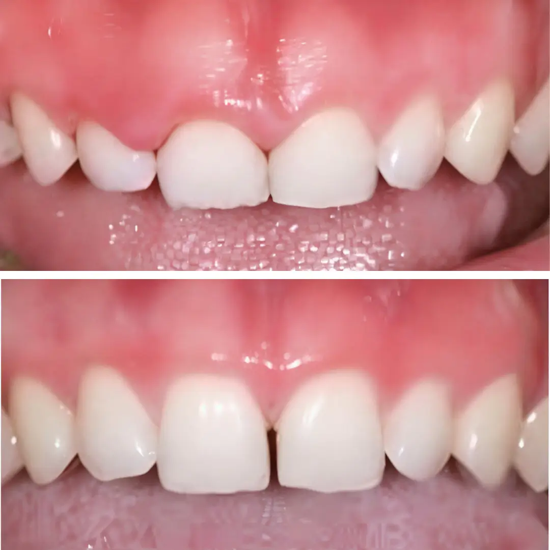 Contour gingival corrigé par chirurgie parodontale au Centre Dentaire Kandil, Mohammedia