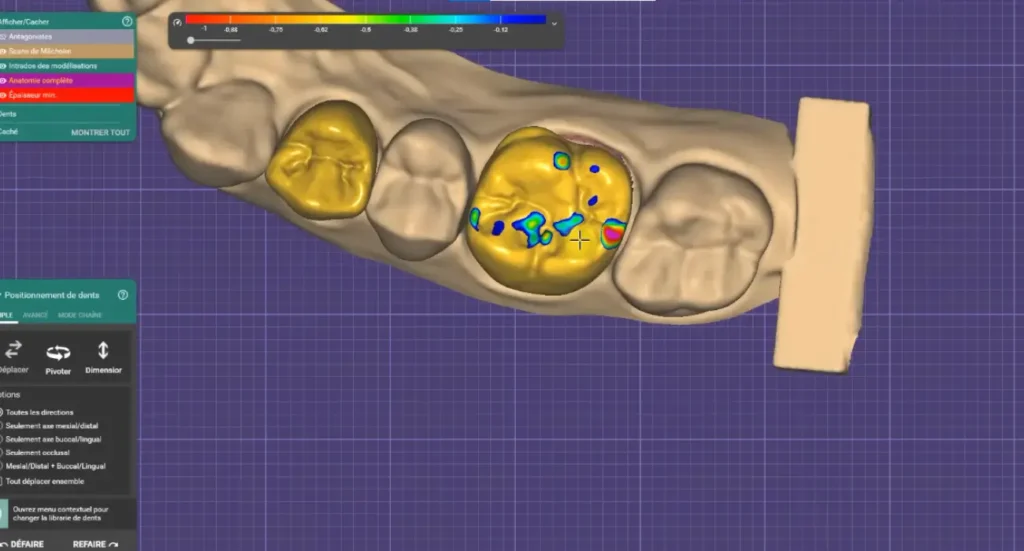 Logiciel de conception 3D utilisé par le Dr Kandil pour ajuster la précision d'une couronne dentaire en Zircone et vérifier l'équilibre de la mastication.