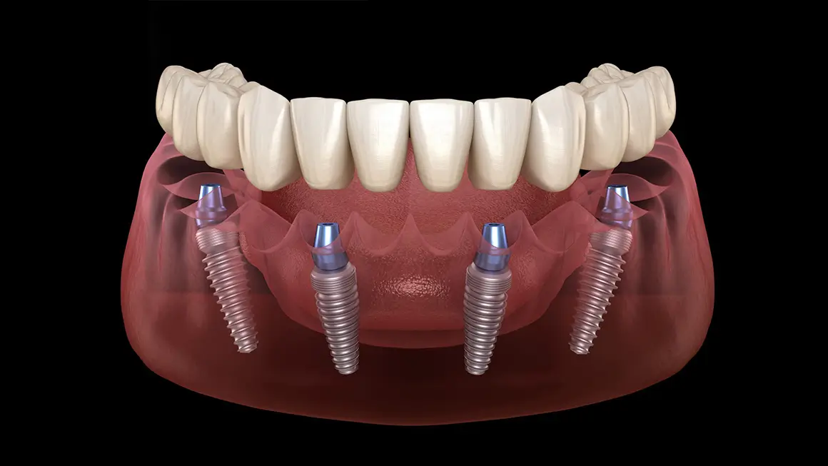 Schéma d'un All-on-4 : quatre implants sous une arcade du bas, les deux du fond inclinés