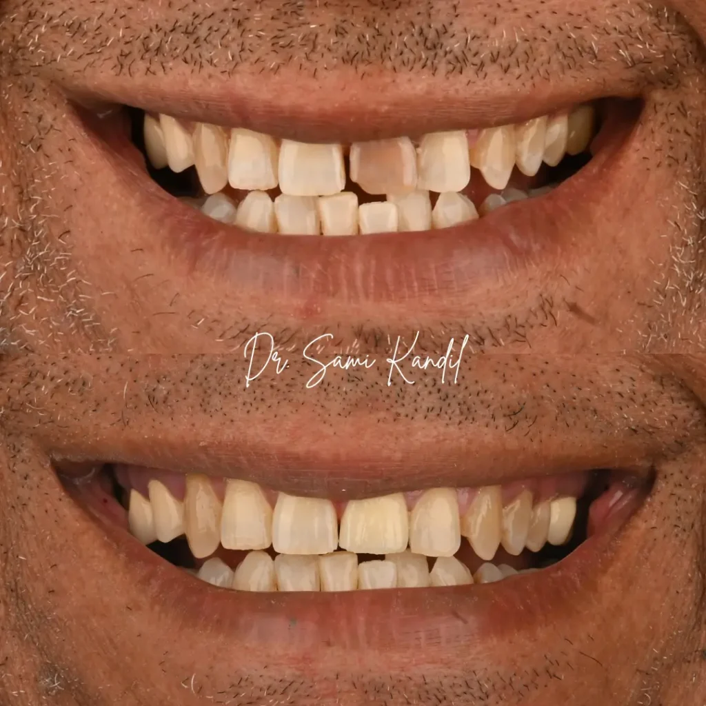 restauration esthetique par couronne dentaire à mohammeida