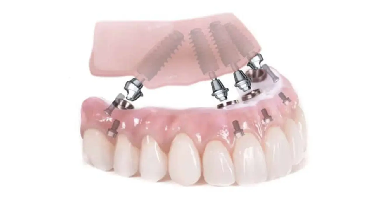 Prothèse fixe vissée sur implants, arcade du haut