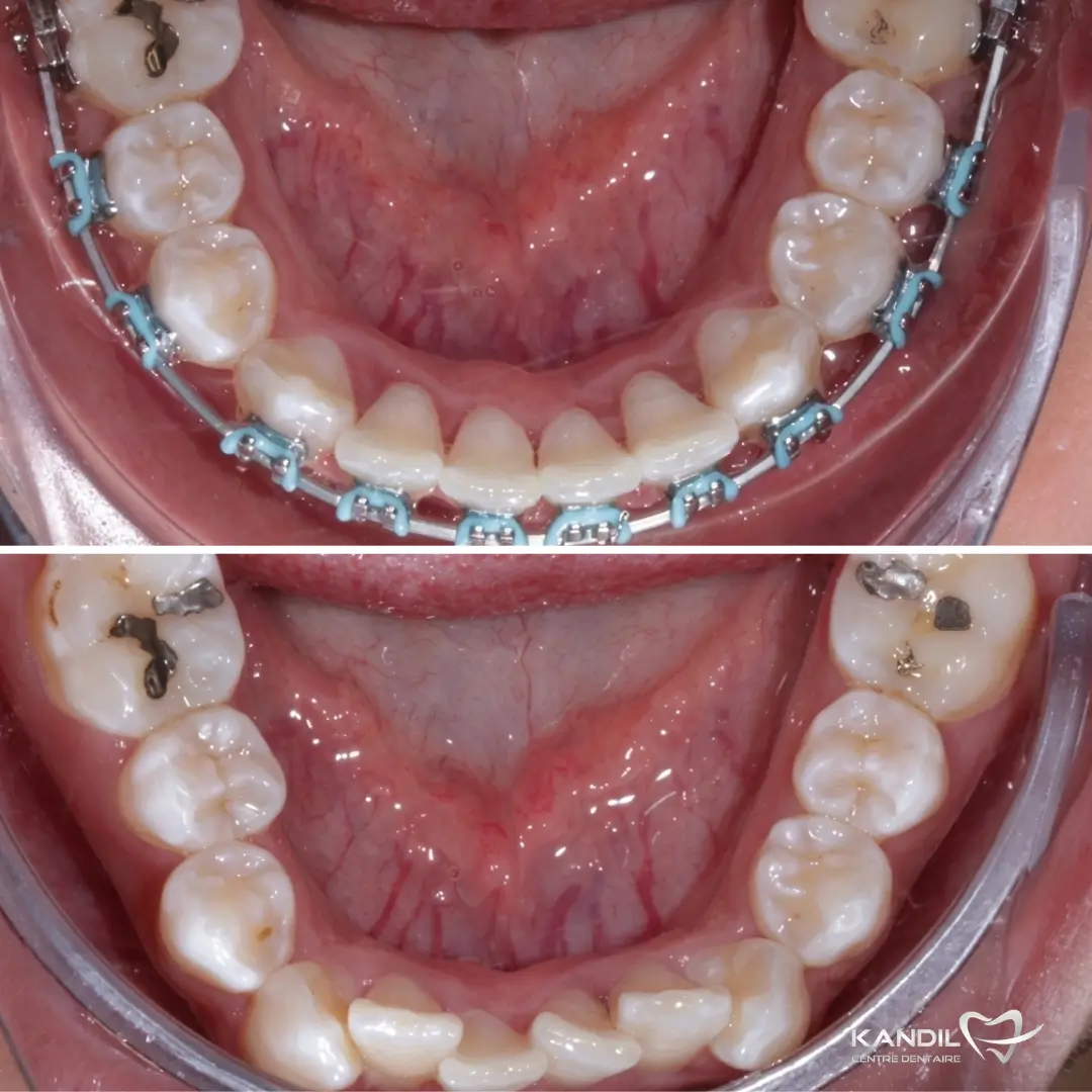 Traitement d'orthodontie avant-après sur l'arcade inférieure au Centre Dentaire Kandil à Mohammedia. La vue occlusale montre la correction d'un encombrement dentaire sévère avec un réalignement parfait des incisives.