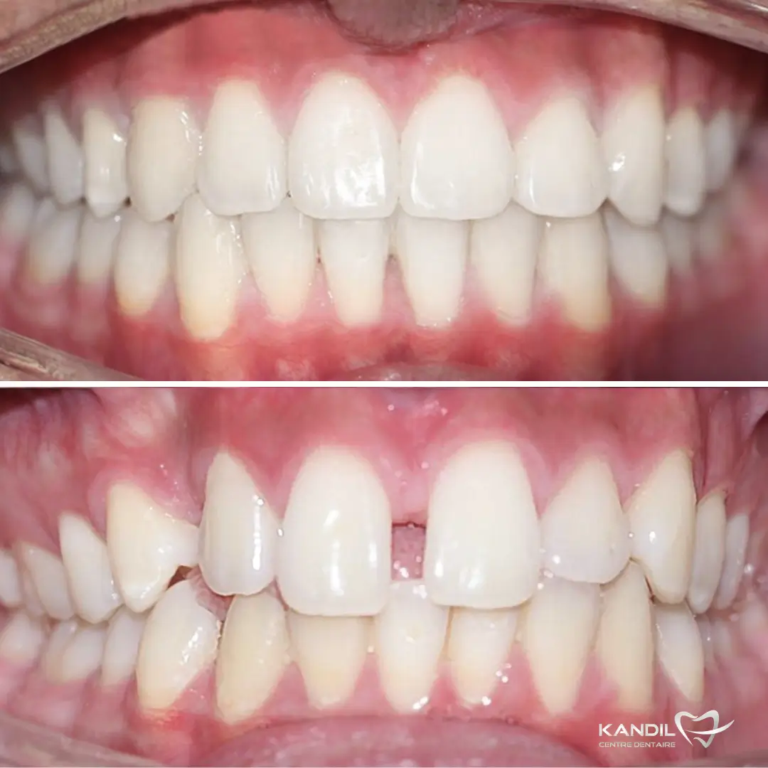 Correction de diastème avant-après réalisée avec les gouttières orthodontiques transparentes personnalisées du Centre Dentaire Kandil à Mohammedia. Fermeture de l'espace entre les dents et alignement du sourire.