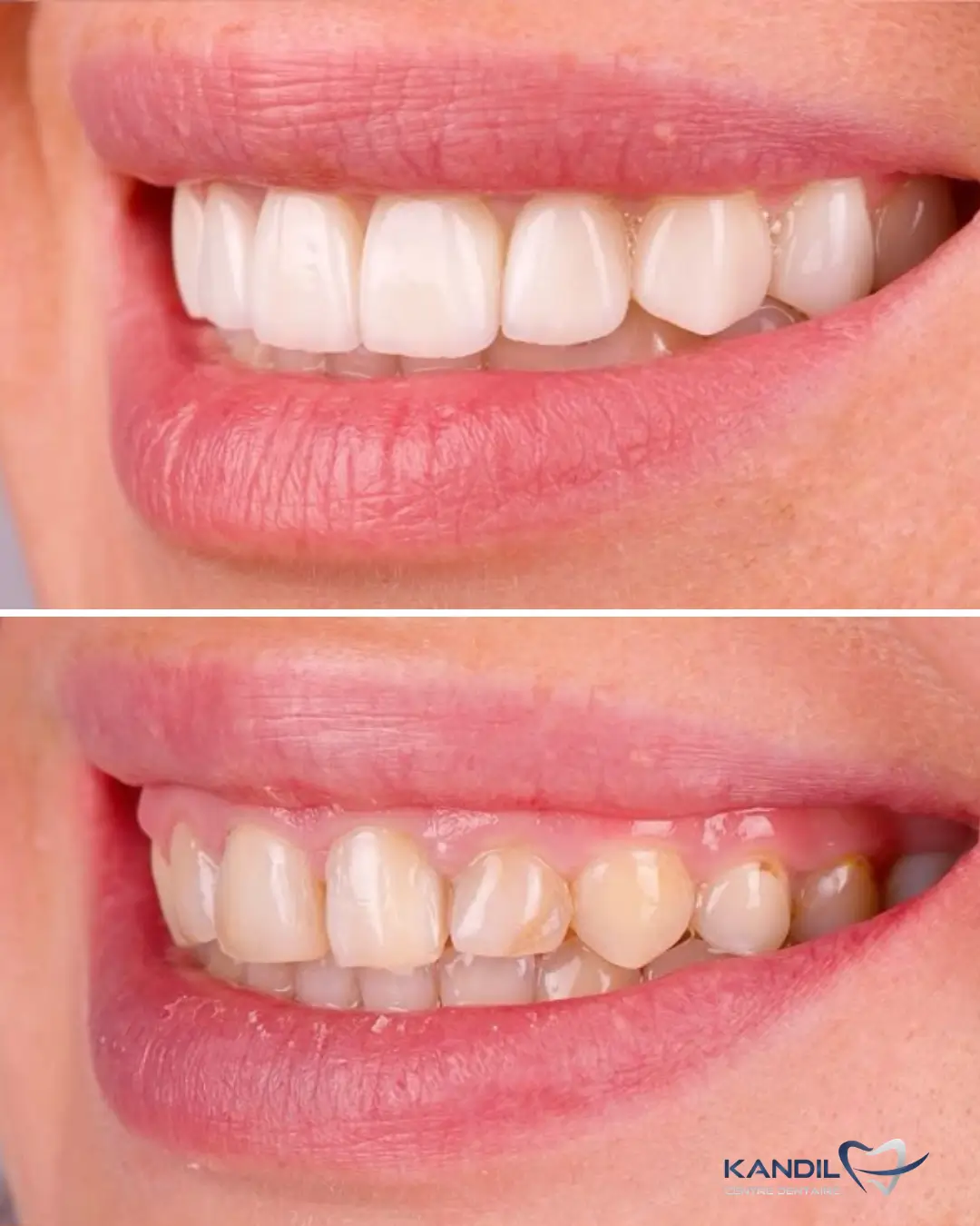 Transformation du sourire avant-après grâce aux facettes dentaires E-Max au Centre Dentaire Kandil à Mohammedia. Correction de la teinte jaune, des légers chevauchements et harmonisation des volumes.