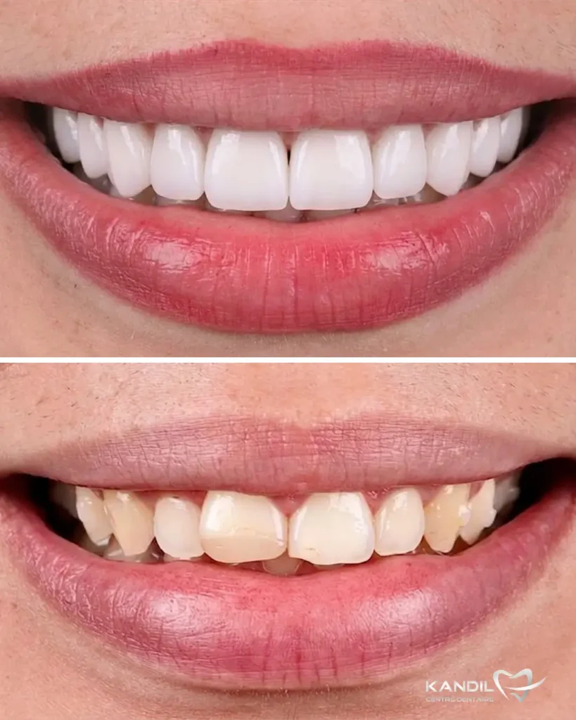 Restauration esthétique avant-après avec pose de facettes céramiques pour un effet Hollywood Smile au Centre Dentaire Kandil à Mohammedia. Alignement parfait, correction des teintes et symétrie du sourire pour un résultat éclatant.