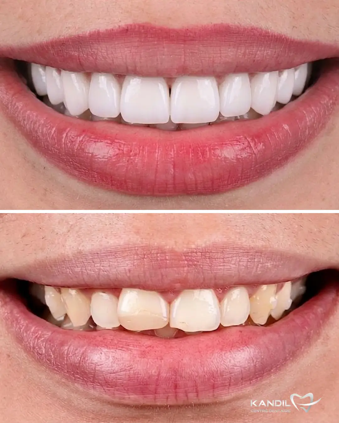 Restauration esthétique avant-après avec pose de facettes céramiques pour un effet Hollywood Smile au Centre Dentaire Kandil à Mohammedia. Alignement parfait, correction des teintes et symétrie du sourire pour un résultat éclatant.