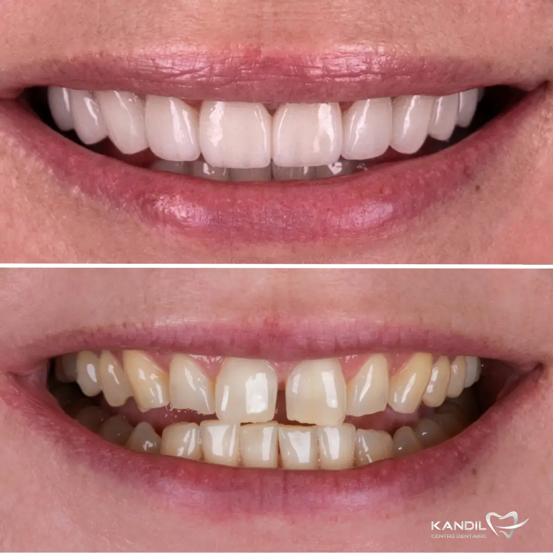 Comparaison avant-après d'un traitement Hollywood Smile réalisé avec des facettes dentaires haut de gamme au Centre Dentaire Kandil à Mohammedia. La photo montre l'alignement parfait et la blancheur éclatante du sourire final face aux dents initiales jaunies et espacées.
