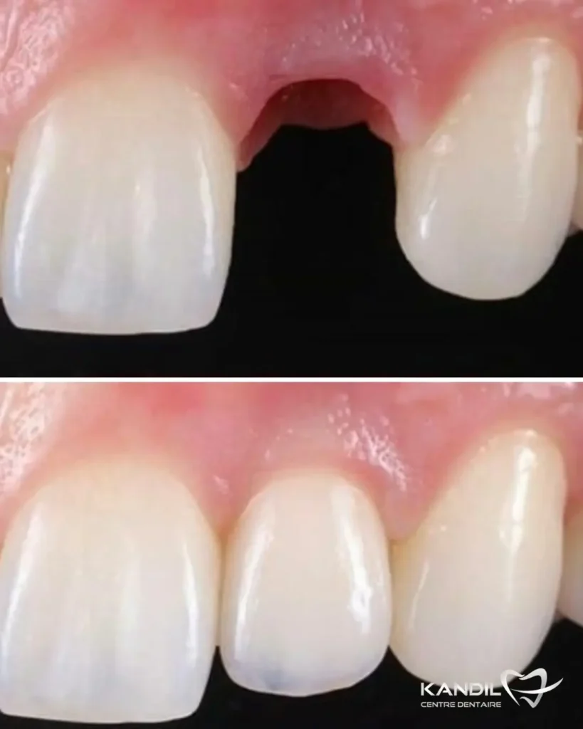 Cas clinique avant-après d'un implant dentaire pour remplacer une incisive centrale supérieure manquante. La vue macro montre l'intégration parfaite de la couronne sur implant avec la gencive au Centre Dentaire Kandil à Mohammedia.